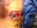 melanomaplaque_281329.JPG