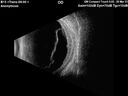 metastatsis_breast1_114906_032823_05.Jpg
