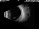 metastatsis_breast1_114906_032823_11.Jpg