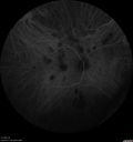 mfc-astrocytoma-ryco_051118_32.jpg