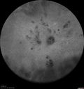 mfc-astrocytoma-ryco_051118_33.jpg