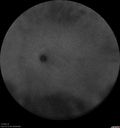 mfc-astrocytoma-ryco_051118_37.jpg