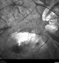 myopic-atrophy-mapa-011719_28329.jpg