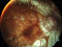 myopic-cnvm_suboy_032720_01.jpg