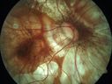 myopic-cnvm_suboy_032720_02.jpg