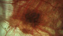 myopic-cnvm_suboy_032720_06.jpg