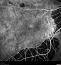 myopic-cnvm_suboy_032720_15.jpg