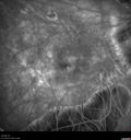 myopic-cnvm_suboy_032720_20.jpg