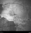 myopic-cnvm_suboy_032720_21.jpg