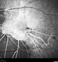 myopic-cnvm_suboy_032720_23.jpg
