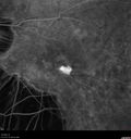 myopic-cnvm_suboy_032720_29.jpg