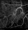 myopic-cnvm_suboy_032720_32.jpg