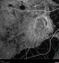 myopic-cnvm_suboy_032720_34.jpg