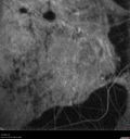 myopic-cnvm_suboy_032720_35.jpg