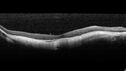 myopicCNVM1_861016_02132023_07.jpg