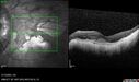 myopicCNVM1_861016_02132023_27.jpg