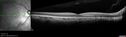 myopiccnvm1_somat_102317_05.jpg