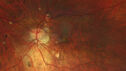 myopiccnvm3_somat_090123_26.jpg