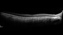 myopiccnvm3_somat_090123_30.jpg