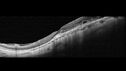 myopiccnvm3_somat_090123_31.jpg