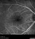 myopiccnvm3_somat_090123_34.jpg