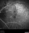 myopiccnvm3_somat_090123_36.jpg