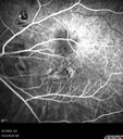 myopiccnvm3_somat_090123_38.jpg