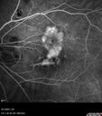 myopiccnvm3_somat_090123_42.jpg