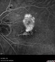 myopiccnvm3_somat_090123_44.jpg