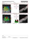 myopiccnvm4_somat_090123_45.JPG