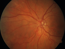nasal-brao_inmur_031618_04.png