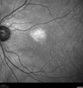 nevus-ir.jpg