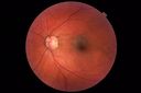 nevus-os-ammc-031218_28229.JPG