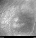 nevus_macas_11171903.jpg
