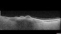 nevus_macas_11171905.jpg