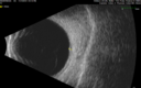 nevus_macas_11171907.png