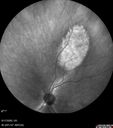 nevus_shvis_8yrold_04.jpg