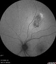 nevus_shvis_8yrold_05.jpg