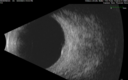 nevus_shvis_8yrold_06.png