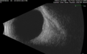 nevus_supa_022118_05.png