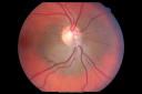 nevusperipapillary_reco02.png