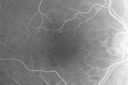 ocularischemiaOD_doro06.jpg