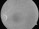 ocularischemiaOD_doro11.jpg