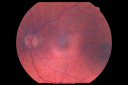 ocularischemiacarotids_chbl03.png