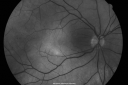 ocularischemiacarotids_chbl05.png