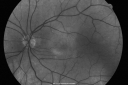 ocularischemiacarotids_chbl06.png