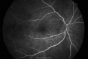ocularischemiacarotids_chbl07.png