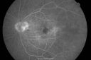 ocularischemiacarotids_chbl16.png