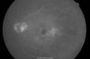ocularischemiacarotids_chbl18.png