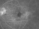 ocularischemiacarotids_chbl19.png